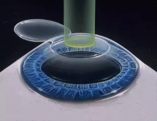 Cirugía Refractiva